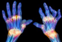 Rapid Spread of Autoimmune Disease around the Globe Rapid Spread of Autoimmune Disease around the Globe