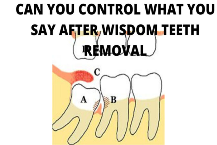 Can You Control What You Say After Wisdom Teeth Removal