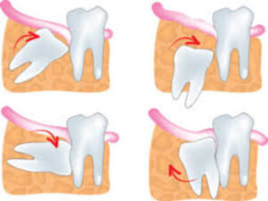 Can You Control What You Say After Wisdom Teeth Removal
