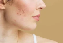 Adult Acne: Causes, Treatment, and Prevention Tips Acne Spots